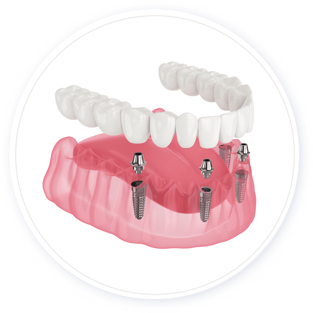 ALLON4イメージ画像