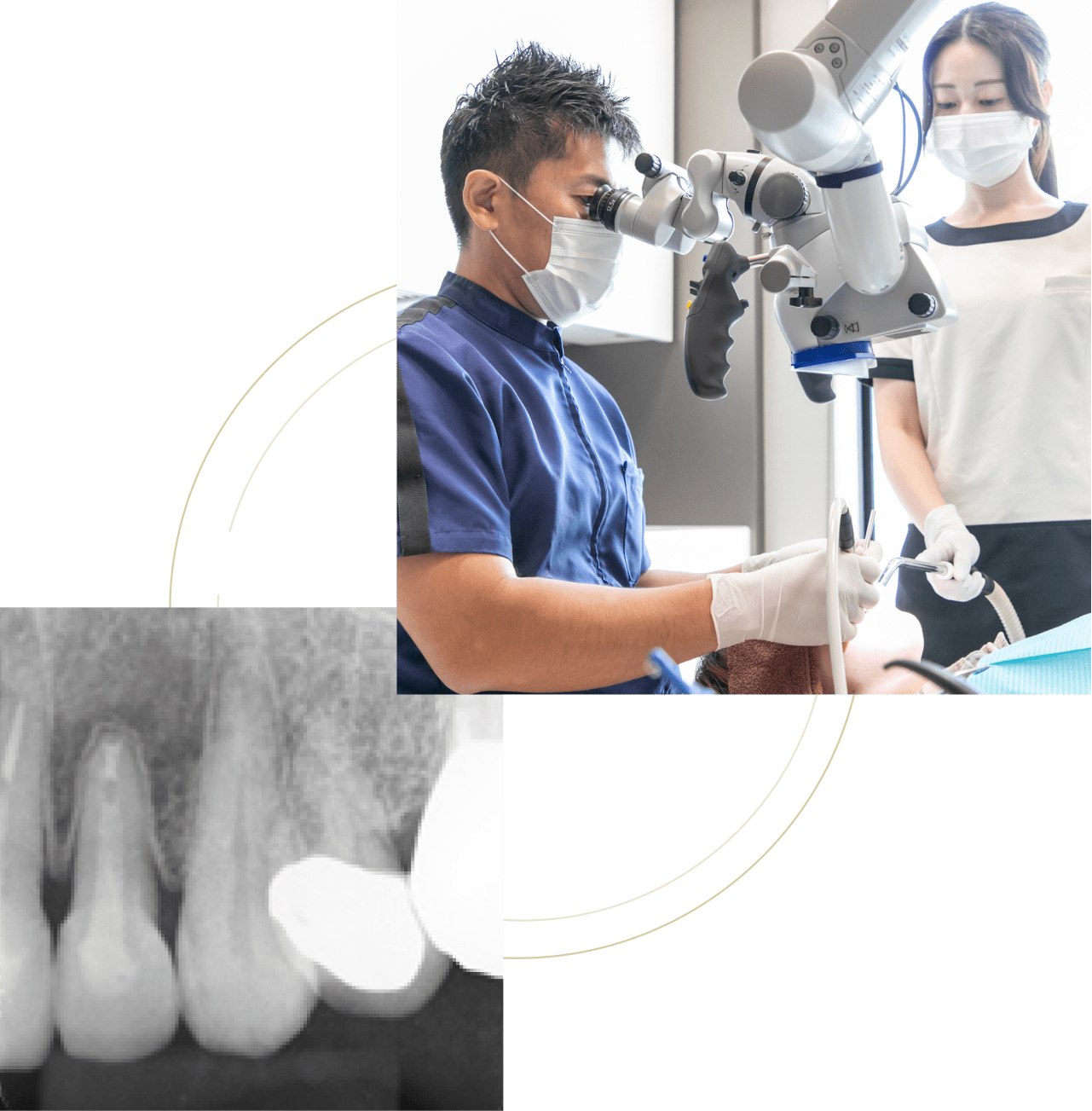 歯根端切除術逆根管充填のイメージ