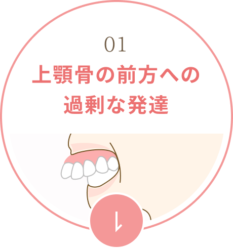 上顎骨の前方への過剰な発達