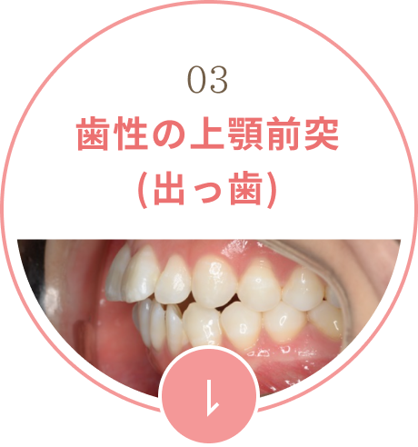 歯性の上顎前突(出っ歯)