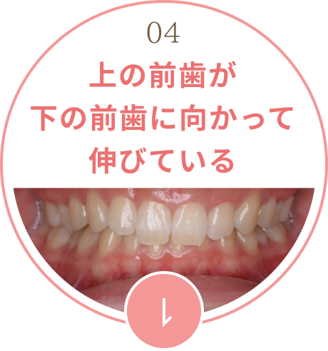 上の前歯が下の前歯に向かって伸びている