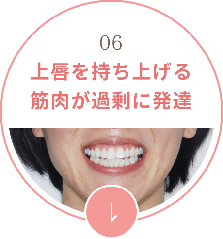 上唇を持ち上げる筋肉が過剰に発達