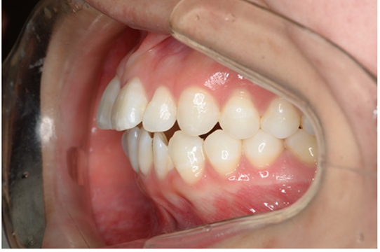 歯性の上顎前突(出っ歯)　症例