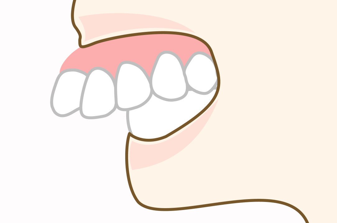 上顎骨の前方への過剰な発達　症例