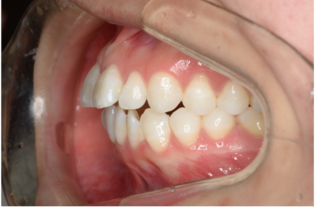 歯性の上顎前突(出っ歯)　症例