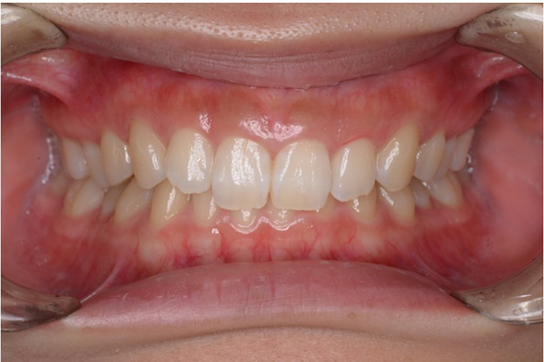 上の前歯が下の前歯に向かって伸びている