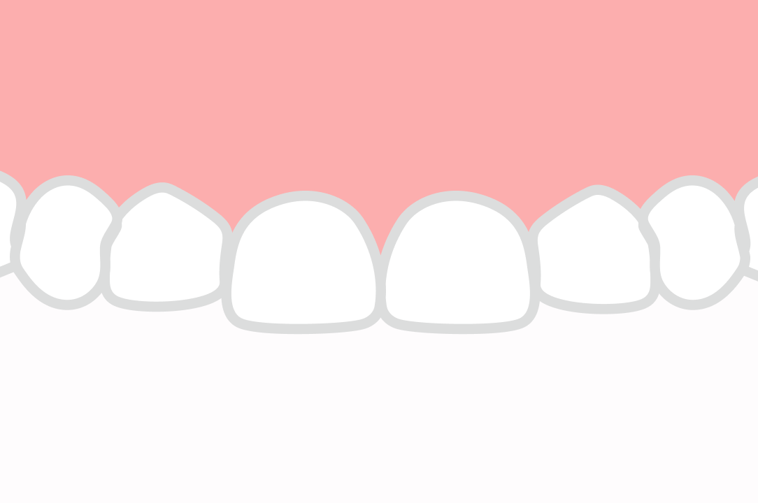 歯の長さが短い・歯が小さい