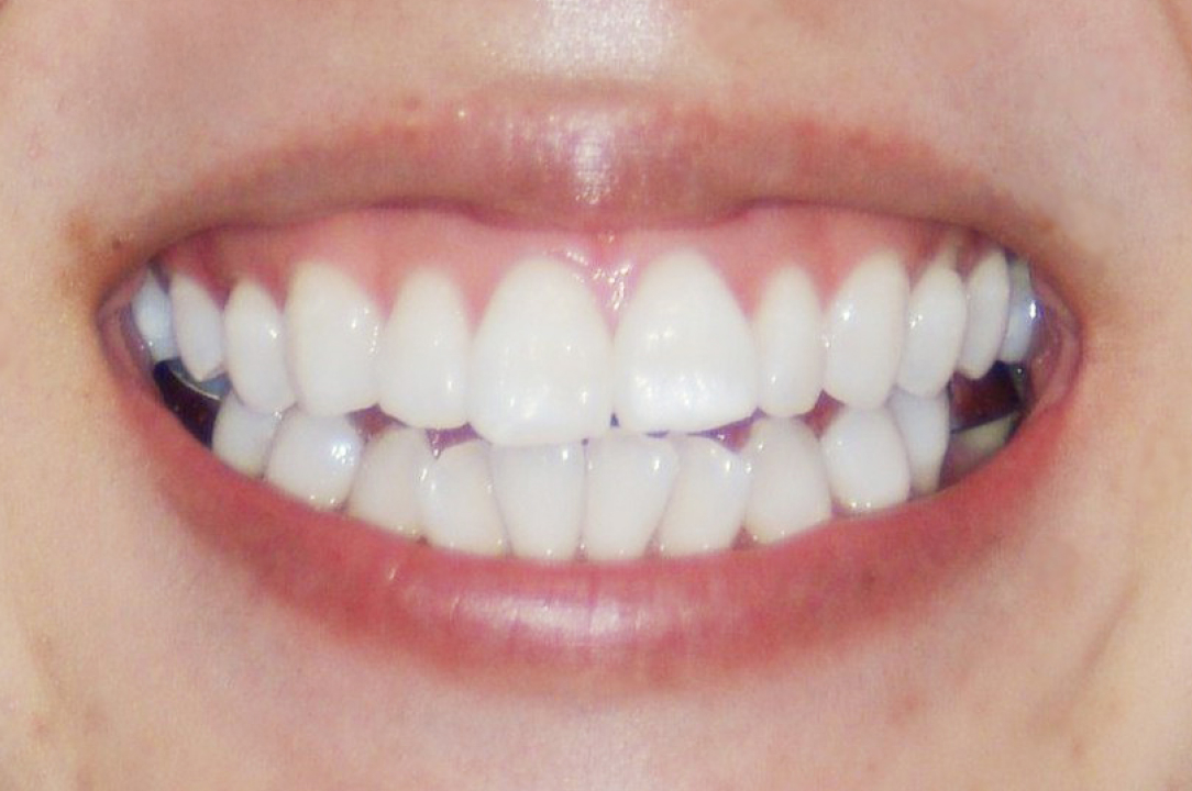 上唇を持ち上げる筋肉が過剰に発達