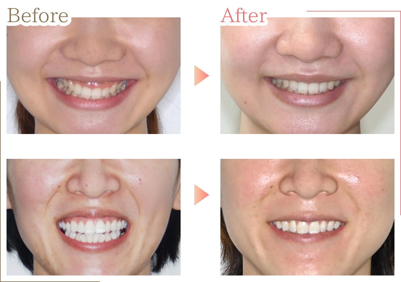 before→afterの症例2つ