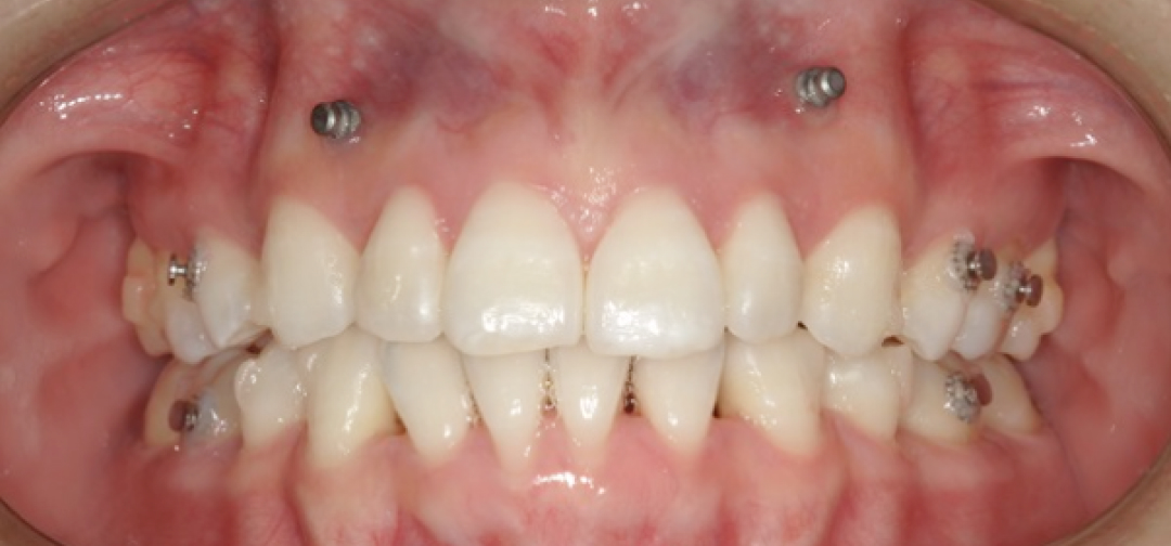 矯正用アンカースクリューを使用した口腔内写真