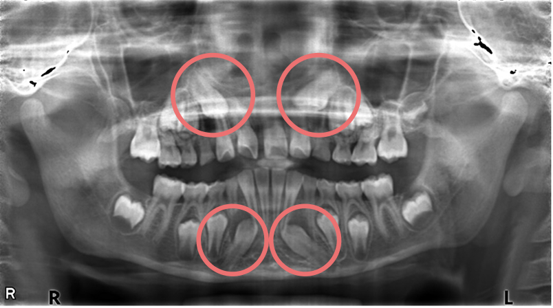 歯胚の位置異常と萌出方向の異常