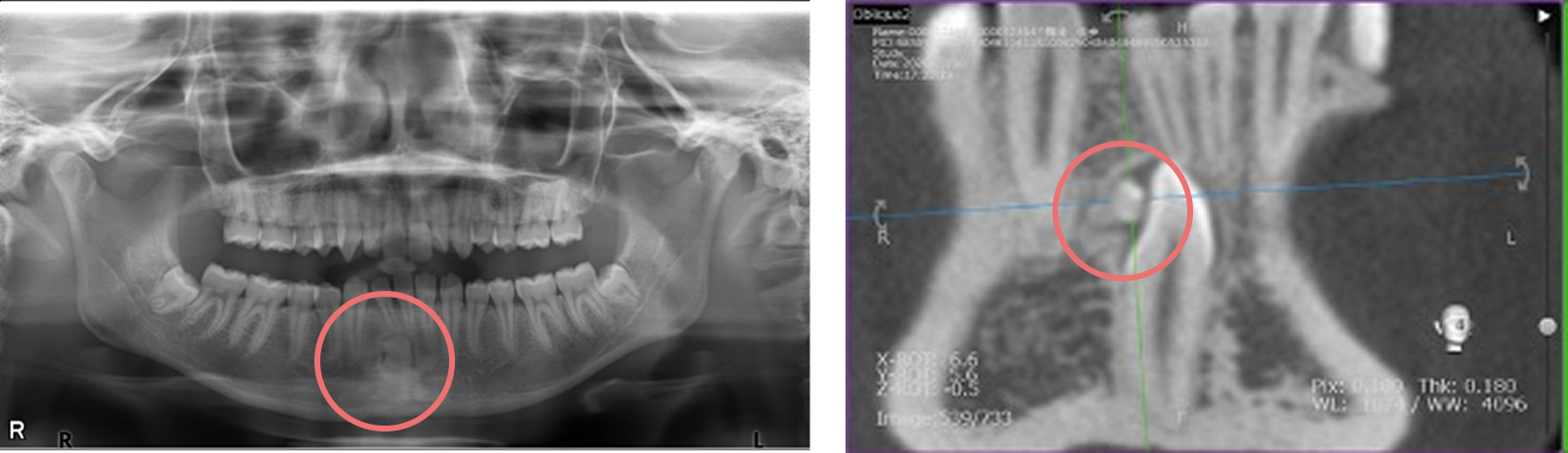 歯牙腫・過剰歯