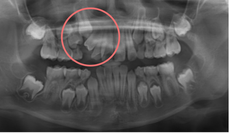 歯胚の位置異常と萌出方向の異常