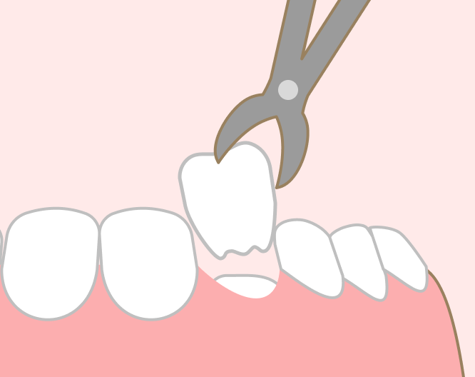 乳歯の抜歯と萌出の促進