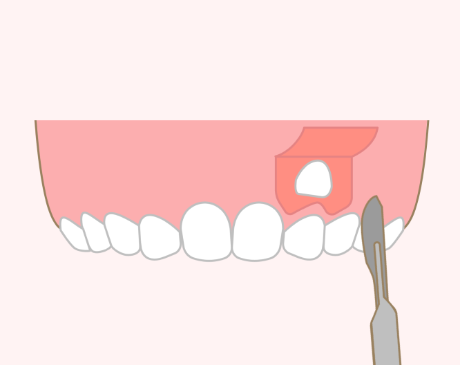 開窓術（歯ぐきを開いて萌出を助ける処置）