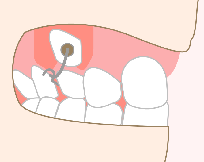 開窓術（歯ぐきを開いて萌出を助ける処置）