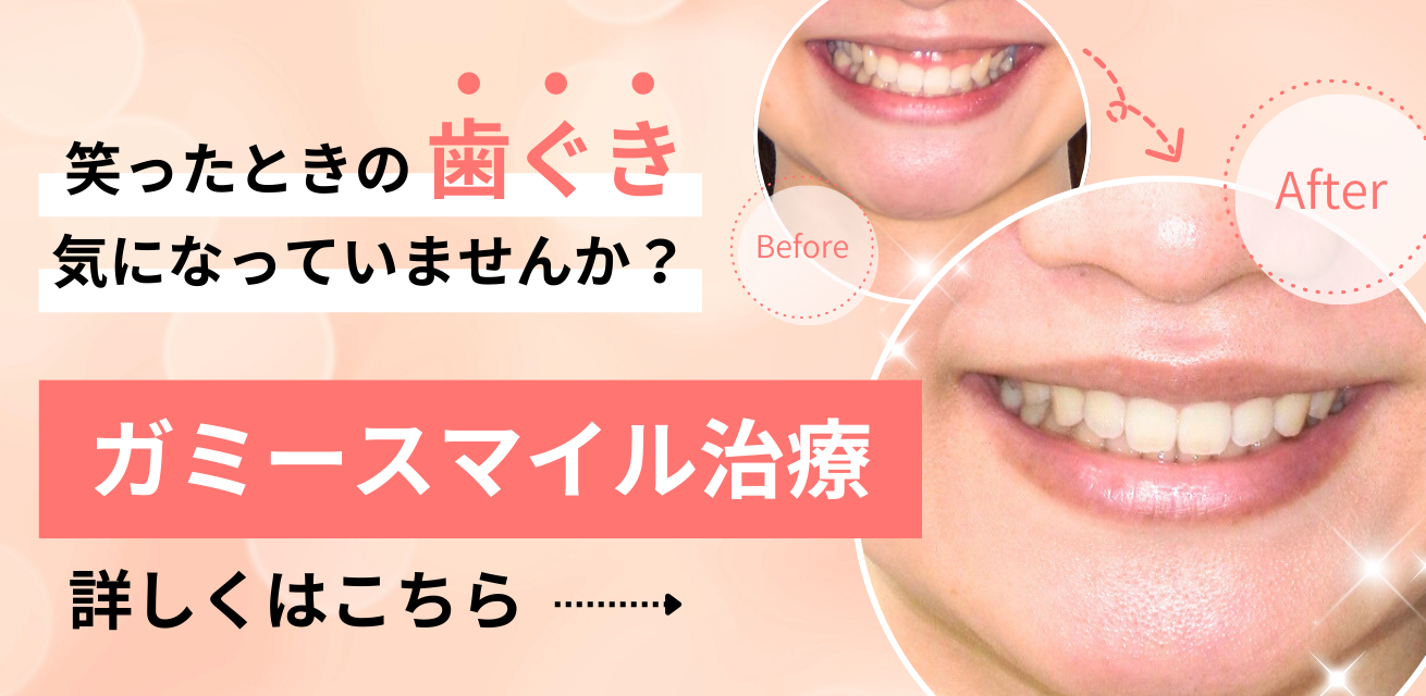 笑ったときの歯ぐき気になっていませんか？ガミースマイル治療 詳しくはこちら
