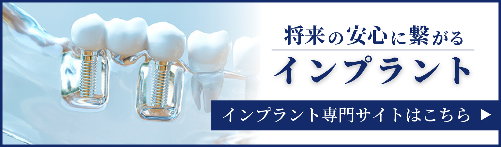 将来の安心に繋がるインプラント インプラント専門サイトはこちら